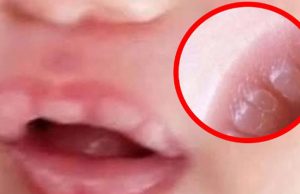 If your baby has these marks, it means