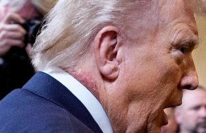 ‘Frank’s Sign’ on Donald Trump’s ear could be a huge indicator that he has a potentially fa.tal health condition